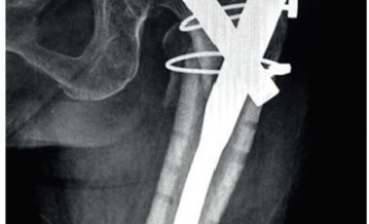 Hệ thống nẹp kim loại CHS